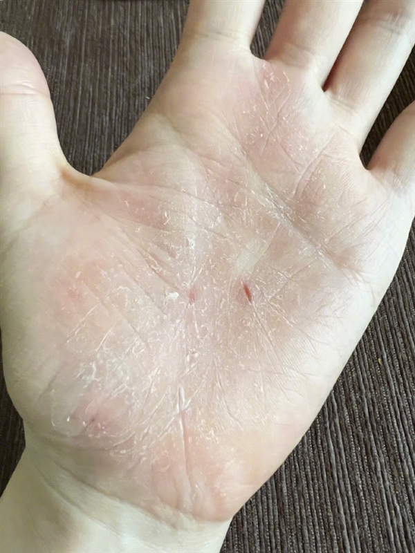 张靓颖自曝体检查出营养不良：额头血管莫名突起 伸懒腰手掌就流血