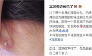 为什么没有人告诉我 打耳洞后会长这种肉疙瘩啊