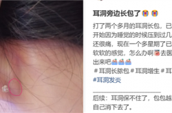 为什么没有人告诉我 打耳洞后会长这种肉疙瘩啊
