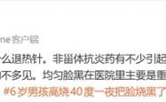 男孩发烧十几个小时：退烧后脸变黑