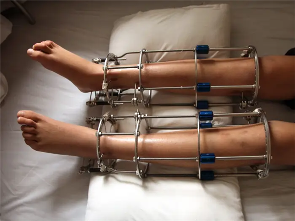 太疯狂!嫌个子太高不好找对象 女子手术切骨变矮