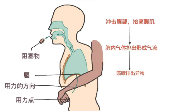 海姆立克急救法更新了:先拍5次背 再做“剪刀石头布” 海姆立克急救法 第2张 海姆立克急救法更新了:先拍5次背 再做“剪刀石头布” 海姆立克急救法 第2张