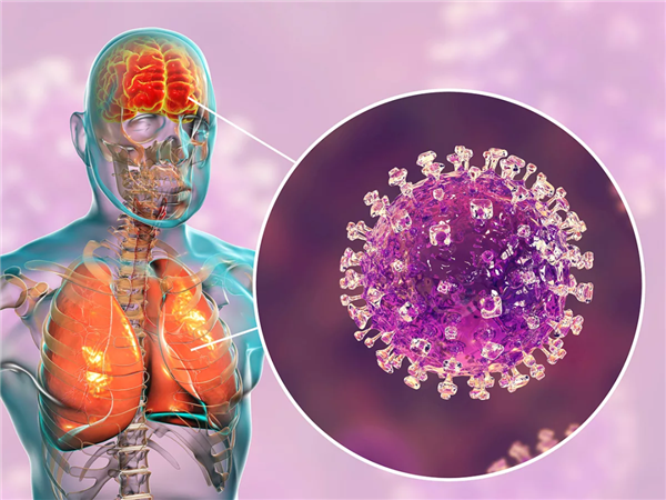 印度这致死率75%的尼帕病毒 真的会成为下一个新冠吗 尼帕病毒 第4张