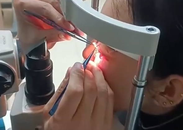 女子误将502喷入眼中睫毛全被拔 就医后保住视力