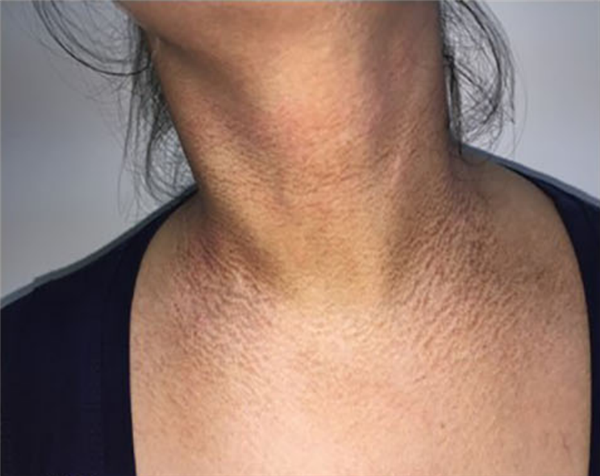 脖子总是黑黑的洗不干净?别大意 这可能是身体在求救