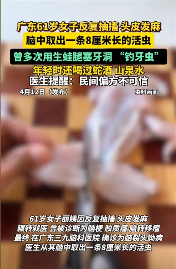 女子听信偏方：脑内取出8厘米活虫