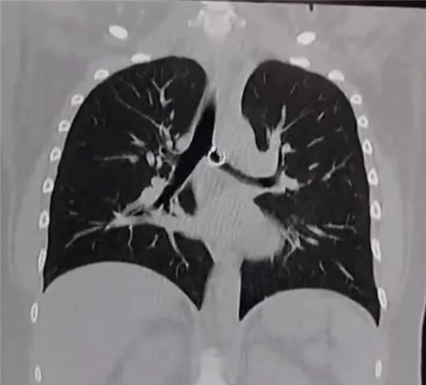 女子咳嗽一个月肺里惊现丢失鼻环 距离死亡仅剩0.5mm!